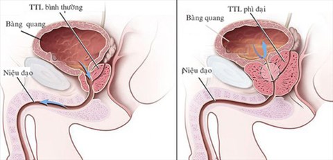 nguyen nhan tieu dem
